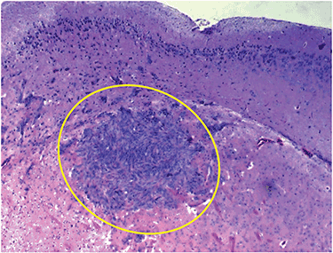 Representative image of breast cancer brain metastasis induced by human CTCs following injection into mice. The work published by Dr. Marchetti’s laboratory in Science Translational Medicine (2013) provides the first-time evidence of CTC isolation from patients’ blood, and the characterization of CTCs possessing metastatic competence in experimental animals. Photo courtesy of Dr. Marchetti. 