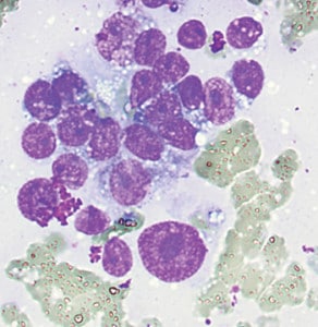 Metastatic ductal carcinoma. Lymph node fine needle aspiration, modified Giemsa stain, high magnification.
