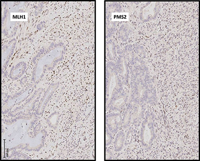 Fig. 2. (A) Immunohistochemical analysis demonstrates that expression of DNA mismatch repair proteins MLH1 and PMS2 is absent in malignant glandular epithelial cell nuclei but intact in malignant spindle cells. Photomicrographs taken at 200×. 