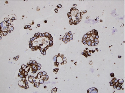 Fig. 6. Cell block technique for cell pellet or tissue fragments—method No. 2, MOC 31 immunocytochemical stain, 20×.