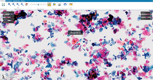 Pap Education Program (2013 PEDM-A case 4)   http://tinyurl.com/lowmmjo Use the link or QR code to see and manipulate the annotated Pap slide with DigitalScope technology and read the discussion (interpretation: LSIL).