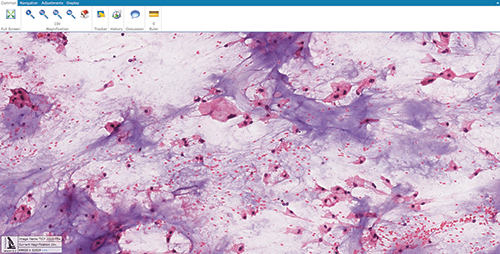 Touch Imprint / Crush Prep Program (TICP-A case 5)   http://tinyurl.com/lz5789x Use the link or QR code to see and manipulate a touch imprint/crush prep slide that uses DigitalScope technology (diagnosis: chordoma).