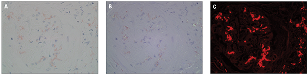 Three photographs (A–C) demonstrate a Congo red-stained paraffin section with kidney glomerulus. A shows the slide viewed in normal light (bright light), B shows the same field viewed under polarized light, and C shows the same field viewed under fluorescence light, using a TRITC filter. While only deposits detected under polarized light are truly diagnostic of amyloid, examination of Congo red-stained slides under fluorescence dramatically increases sensitivity.