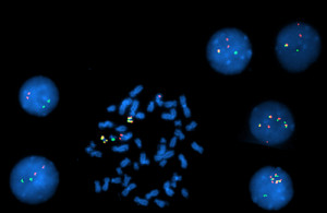 Fig. B. Interphase and metaphase FISH studies showed: A nuclear fusion signal with an extra red signal in 1.5 percent of the interphases indicating Ph+ cells; two nuclear fusion signals in two percent of interphases indicating Ph+ cells with an extra copy of the BCR-ABL1 gene fusion; four nuclear fusion signals in eight percent of interphases indicating Ph+ cells with three extra copies of the BCR-ABL1 gene fusion; 88.5 percent of the cells were Ph negative.