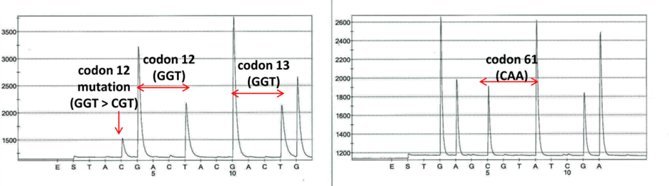 Fig. D. Pyrosequencing analysis of codons 12, 13, and 61 of NRAS. A mutation detected in codon 12 of NRAS (NM_002524: c.34G>Cp.G12R). No mutations detected in codons 13 or 61.
