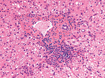 From chapter on liver donor organ evaluation (to be published next month in cap today): Mild portal inflammation. Donor organs may exhibit mild portal inflammation with or without bile ductular proliferation. These changes are common and are not a contraindication to transplantation.