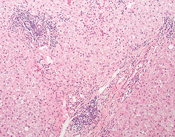 Fig. 3.1.10. Chronic hepatitis. Portal inflammation is seen in this hepatitis-C–positive “extended-criteria” donor. This finding is expected and is not a contraindication to use of this organ in selected clinical settings. 