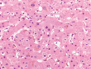 Fig. 3.1.11. Iron overload in donor liver. Hepatocellular and sinusoidal iron pigment is evident on the hematoxylin-eosin (H&E)–stained slide in this donor liver biopsy.