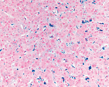 Fig. 3.1.12. Iron overload in donor liver, Prussian blue stain. A Prussian blue stain performed on the biopsy illustrated in Figure 3.1.11 confirms mild iron accumulation in hepatocytes and Kupffer cells. 