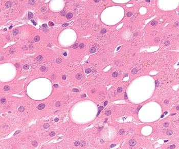 Fig. 3.1.4. Macrovesicular steatosis. In macrovesicular steatosis, one or a few round fat droplets displace the hepatocyte nucleus to the edge of the cell. 