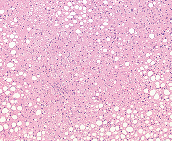 Fig. 3.1.6. Moderate macrovesicular steatosis (30%–60%). Although this liver contains greater than mild steatosis, it may be considered acceptable for use in selected settings. 