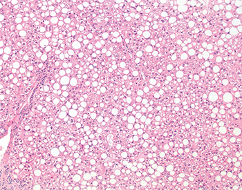 Fig. 3.1.7. Severe macrovesicular steatosis (>60%). This graft was found to be severely steatotic (80% steatosis overall) on routine time-zero biopsy; no frozen section was performed prior to implantation. Although in this case the organ functioned well and the recipient experienced a normal posttransplant recovery, severely steatotic livers would not be used in most settings if detected prior to implantation. 