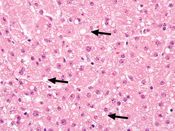 Fig. 3.1.8. Small droplet steatosis. This previously frozen biopsy demonstrates scattered small fat droplets (arrows) that neither fill the cell nor displace the nucleus. These droplets resolve after implantation of the liver and do not impact graft function.