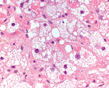 Fig. 3.1.9. Microvesicular steatosis. Numerous tiny fat droplets surrounding the hepatocyte nucleus impart a foamy or finely vesicular appearance to the hepatocyte. This change is rare in livers being evaluated for potential transplantation. 