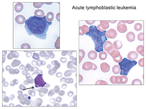 Fig.2. Arrowed image identifies azurophilic granules which can sometimes be seen, so-called granular acute lymphoblastic leukemia. (Images in Figs. 2–6 from Atlas of Peripheral Blood: The Primary Diagnostic Tool. Pereira I, George TI, Arber DA. Philadelphia: Wolters Kluwer/Lippincott Williams & Wilkins; 2012.)