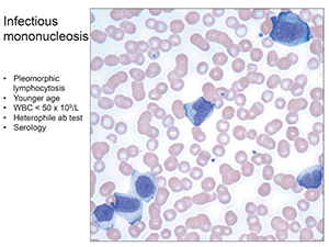 Fig.4. Infectious mononucleosis: Pleomorphic lymphocytosis, younger age, WBC < 50 x 109/L, heterophile ab test, serology.