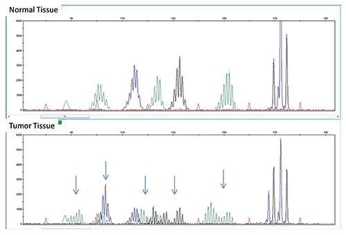 Fig. 3: MSI assay showing multiple sites of instability in tumor tissue (bottom) compared with normal tissue (top). A panel consisting of five mono/dinucleotide markers was used for MSI determination via multiplex PCR. The amplified products were separated by capillary gel electrophoresis. Comparison of peak patterns with a shift in PCR product size of the tumor when compared with normal represents instability. The arrows represent shifts in base pairs as compared with normal tissue.