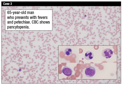 cytopeniasCase3