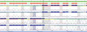 Fig. 4: Chromatogram of Sanger sequencing confirming the findings by next-generation sequencing. (See Fig. 3.)