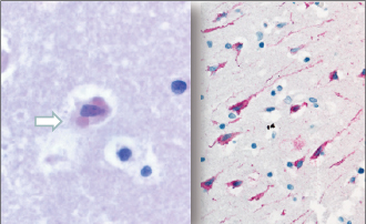 Rabies transmission through solid organ transplantation, 2013. Courtesy Sherif Zaki, MD, PhD.