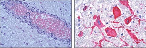 West Nile virus (left, histopath; right, IHC). Courtesy Sherif Zaki, MD, PhD.