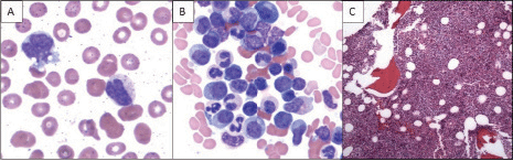 Fig. 2. A) Peripheral blood with circulating myeloid precursor and monocyte. B) Bone marrow aspirate with mild multilineage dysplastic changes. C) Bone marrow core biopsy with hypercellular marrow. Blasts are not increased and there is no significant reticulin fibrosis.