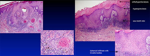Left: the more atypical area of the lesion that could be misinterpreted as squamous cell carcinoma. Right:  the peripheral area of the lesion with characteristic features of hypertrophic lichen planus. The pitfall is overcalling the first area as malignant as the lesion is benign.