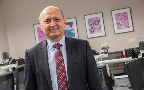 Dr. Netto’s area of interest lies in early detection markers. “We’re beginning to prove that genetic alterations in urine samples tightly mirror those in associated bladder tumors, and we’re finding some encouraging results in terms of developing a very specific assay for a bladder cancer detection screen,” he says. The panel of urine genetic markers is applicable also to surveillance.