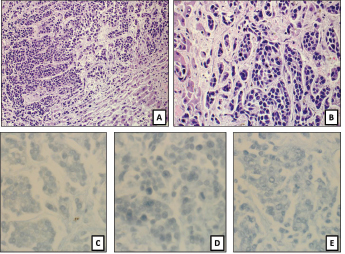 Fig. 1. (A), (B): H&E of sections of a liver nodule show pleomorphic small blue round tumor cells growing in nests and trabeculi, suggesting a poorly differentiated neuroendocrine carcinoma. Mitoses are present. Tumor cells are completely negative for (C) S-100, (D) synaptophysin, and (E) chromogranin.