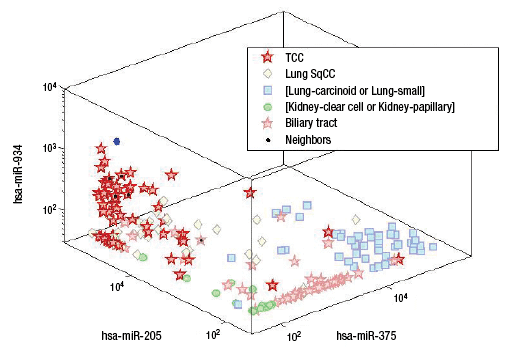 Fig. 3. K-nearest-neighbor (KNN) from Rosetta Cancer Origin Test (courtesy of Rosetta Genomics). The full KNN analysis compares the expression across all 64 microRNAs used for the test on the 1,282 training samples. The majority diagnosis among the nearest five samples is determined.  This figure shows a simplified version of KNN results in three-dimensional space. Only the expression of three microRNAs (instead of 64 microRNAs) and only the most likely differential diagnoses (instead of all 1,282 tumors in the training set) are shown. Our patient sample is depicted as a blue dot. The five nearest neighbors in the complete training set are marked with a black dot on top of the symbol representing the reference diagnosis. Four of the nearest neighbors were urothelial carcinomas, and one of the nearest neighbors was a biliary tract cancer. (TCC: urothelial carcinoma, SqCC: squamous cell carcinoma, hsa-miR-205, hsa-miR-375, hsa-miR-934: three microRNAs selected for this image.)