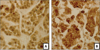 Fig. 4. Based on the Cancer Origin Test results, additional stains for GATA3 (A) and uroplakin (B) were performed and were positive, confirming the molecular identification of this tumor as urothelial carcinoma.