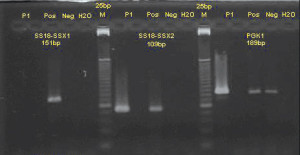 Fig. 3. Gel electrophoresis following reverse transcriptase polymerase chain reaction showing the absence of the 151 bp band in the patient lane designated P1 in the left one-third of the image, and the presence of a 109 bp band in the lane designated P1 in the mid-third of the image, in the presence of appropriate positive and negative controls (lanes designated “pos” and “neg” respectively), with amplification of the reference PGK1 gene (right one-third of the image), confirming the presence of the SS18-SSX2 fusion transcript in the analyzed tissue.