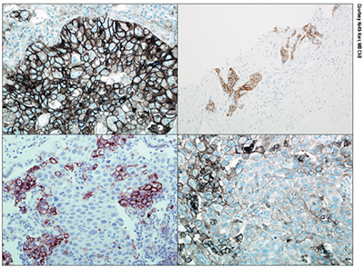 Non-small cell lung cancer samples stained with the 28-8 Dako IHC assay. The top two images show widespread tumor cell membrane staining. Bottom right also shows membrane staining but note the variability, with significant numbers of negative tumor cells. Bottom left shows membrane staining in macrophages, but no staining in tumor cells.