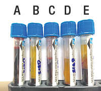 Citrate tubes illustrating various collection volumes, hematocrits (Hct), and the corresponding plasma volumes. A and B: Appropriately filled citrate tube and corresponding plasma volume (Hct: 42.3 percent). C and D: Underfilled citrate tube and corresponding plasma volume (Hct: 42.3 percent). E: Appropriately filled citrate tube with reduced plasma volume from a sample with an increased hematocrit (Hct: 65.6 percent). Note: the reduced plasma volume is similar to that of an underfilled tube (tube D).