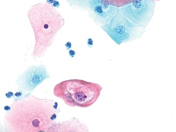 Fig. 1. One typical koilocyte (600×) with peri-nuclear cavitation and nuclear enlargement.