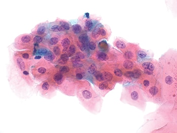 Fig. 3. One cluster of LSIL cells (600×) with nuclear enlargement and eosinophilic cytoplasm and no perinuclear cavitation.