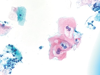 Fig. 4. One small cluster of LSIL cells (600×) with perinuclear cavitation, binucleation, and slightly enlarged nuclei.