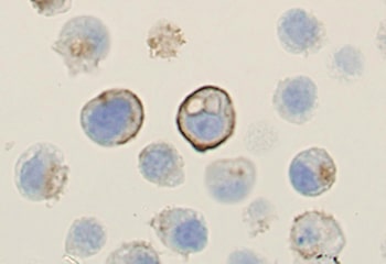 Metastatic ductal carcinoma. Lymph node fine needle aspiration, positive HER2 immunocytochemistry, high magnification.