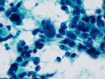Medullary carcinoma. Thyroid fine needle aspiration, Papanicolaou stain, high magnification.