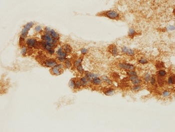 Medullary carcinoma. Thyroid fine needle aspiration, calcitonin immunocytochemical stain, high magnification.