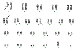 Fig. 4. Bone marrow chromosome analysis revealed a complex karyotype that included the t(6;7)(p25.3;q32.2) resulting in DUSP22 gene rearrangement in four of 20 metaphase cells.