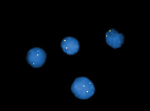 Fig. 5. Interphase fluorescence in situ hybridization analysis using a DUSP22 break apart DNA probe confirmed DUSP22 gene rearrangement (abnormal hybridization pattern consisting of one red, one green, and one fusion signal).