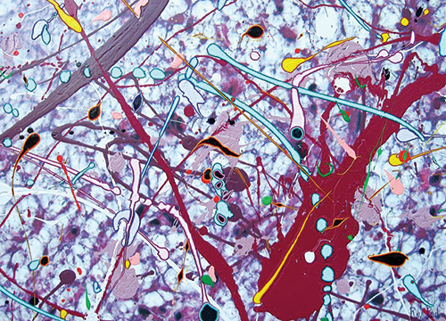 One of three pieces of art in the book by Ray Paul, titled “My Sarcoma #2.” Acrylic, latex, and enamel on canvas printed with a photographic image of the metastatic sarcoma to his lung. “This piece is my attempt to face my cancer head-on through my artwork. I am throwing all of my paint, energy, and soul into this battle,” he writes.