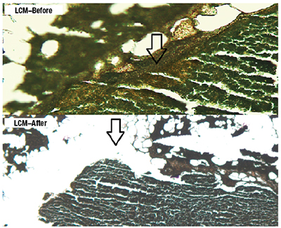 Fig. 2. Laser capture microdissection was performed on the slides, which were cut prior to the final H&E stain. This graphic shows the slides that were stained using the Arcturus Paradise Stain (Thermo Fisher) and the results of before and after the laser dissection process.