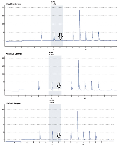 Fig. 3. Appropriate positive and negative controls are seen (as indicated by the arrows) for the BRAF V600E pyrosequencing assay followed by results of the patient sample which indicate the presence of a mutation. The test sensitivity or low limit of detection is validated at five percent mutant allele.