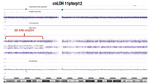 Fig. 2. Chromosome genomic array testing (CGAT) identified copy neutral loss of heterozygosity (cnLOH) of the short arm of chromosome 11 as the sole molecular abnormality. The X axis denotes genomic location (short arm 11p on the left and long arm 11q on the right separated by the centromere region with no probe coverage; see chromosome 11 ideogram on the bottom), while the Y axis denotes log2 ratio of the copy number (upper panel) and the allelic track (middle panel). Each blue/purple dot corresponds to a probe on the array. Chromosome 11q shows the normal allelic track pattern whereas 11p demonstrates cnLOH (splitting of the middle track) from the telomere (11pter) to band 11p12 (38 Mb in size) in approximately 30 percent of cells. There is no copy number aberration evident.