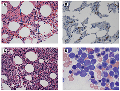 Fig. 1. Representative bone marrow morphological findings. (A) Bone marrow from the patient (same specimen as the CGAT) showing a hypocellular marrow with relative erythroid hyperplasia and dysplastic megakaryocytes (blue arrows). Stain: H&E, image taken with 40× objective. (B) Bone marrow from the patient (same specimen as the CGAT) showing a hypocellular marrow with increased scattered blasts (cells with brown pigment staining). Stain: CD34 immunohistochemistry, image taken with 40× objective. (C) Bone marrow core from the patient four months after CGAT study showing cnLOH. The marrow was hypercellular with increased immature mononuclear cells, which are the blasts. H&E-stained section, image taken with 40× objective. (D) Bone marrow aspirate from the patient four months after CGAT study showing cnLOH. This aspirate shows dysplastic features such as irregular nuclear contours and nuclear buds in the erythroid precursors with increased blasts (approximately 15 percent overall) in the marrow. Stained with Wright Giemsa, image taken with 100× objective.