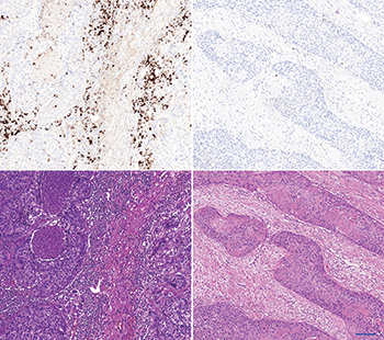 The left panel shows an “inflamed” carcinoma. The upper left shows a strong PD-L1 immune cell staining by SP142/ Ventana. The lower left shows the corresponding HE stain. The stroma is cell rich and contains a high density of immune cells. The right panel shows an “immune desert” carcinoma. The upper picture shows a negative PD-L1 immune cell staining by SP142/ Ventana. The lower right shows the corresponding HE stain. The stroma is fibrous and contains fibroblasts without immune cells. Scalebar is 100 µm.