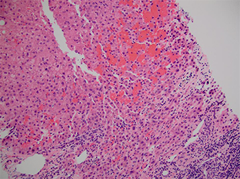 Fig. 2. Acute toxic liver injury caused by over-the-counter weight-loss supplements