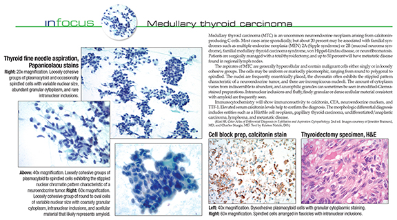 CAPTODAY_MedullaryThyroidCarcinoma_Button